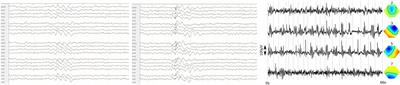 Schizophrenia Associated with Epileptiform Discharges without Seizures Successfully Treated with Levetiracetam